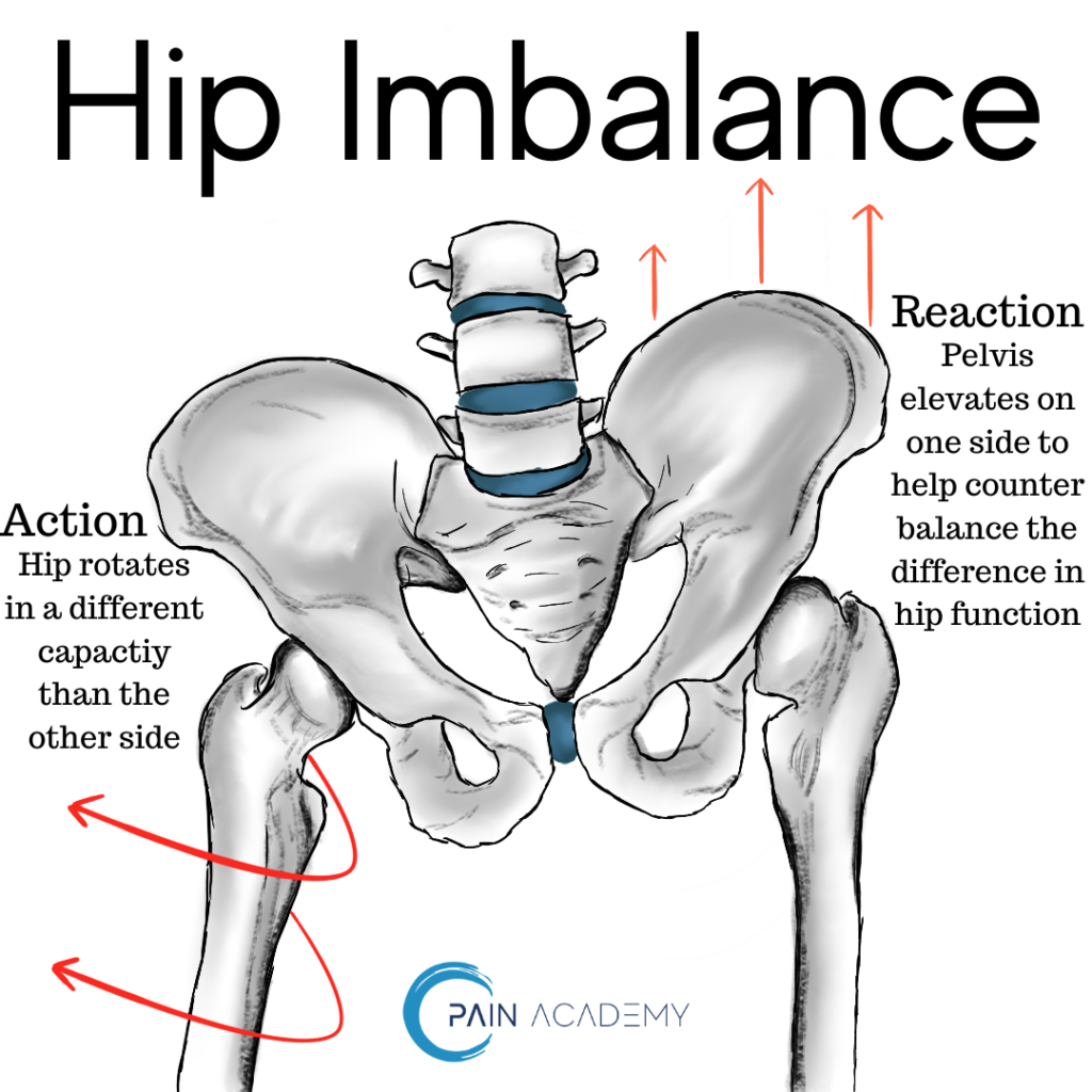 Hip Imbalance – Pain Academy