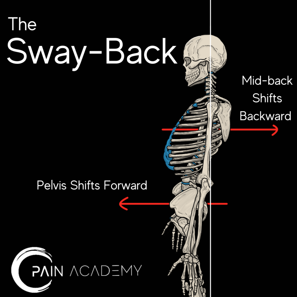 Swayback Posture